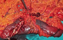 Mide Kanseri Cerrahisi: Ameliyat sonrası çıkarılan mide spesmeni.