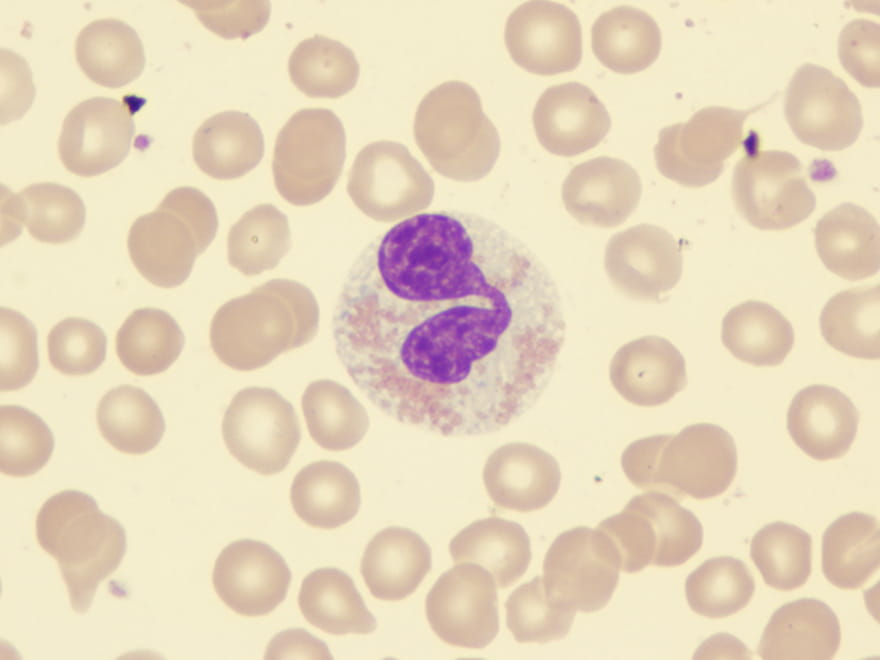 Miyelodisplastik Sendrom