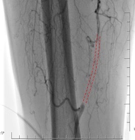 %100 tıkalı bacak atardamarı (Kesikli çizgiler damarın normal hattını gösteriyor)
