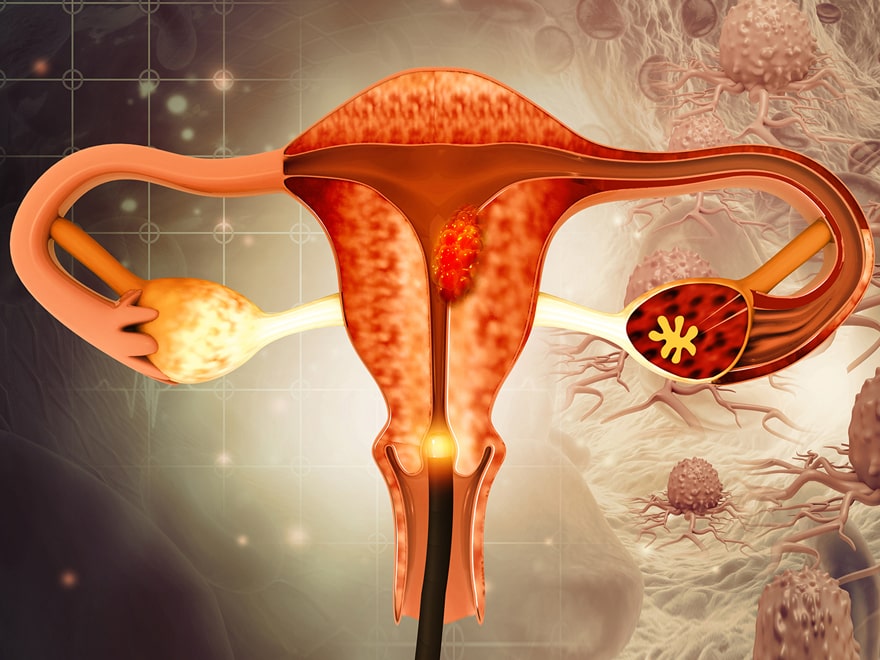 Serviks (Rahim Ağzı) Kanseri: Erken Tanı Hayat Kurtarır