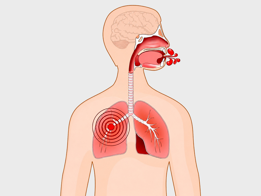 Hemoptizi (Kanlı Balgam) Nedir? Neden Olur?