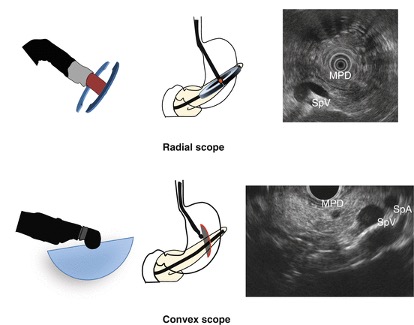 Endoskopik Ultrasonografi EUS Nedir